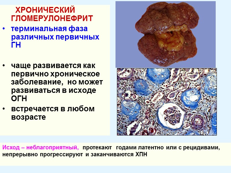 ХРОНИЧЕСКИЙ ГЛОМЕРУЛОНЕФРИТ терминальная фаза различных первичных ГН   чаще развивается как первично хроническое